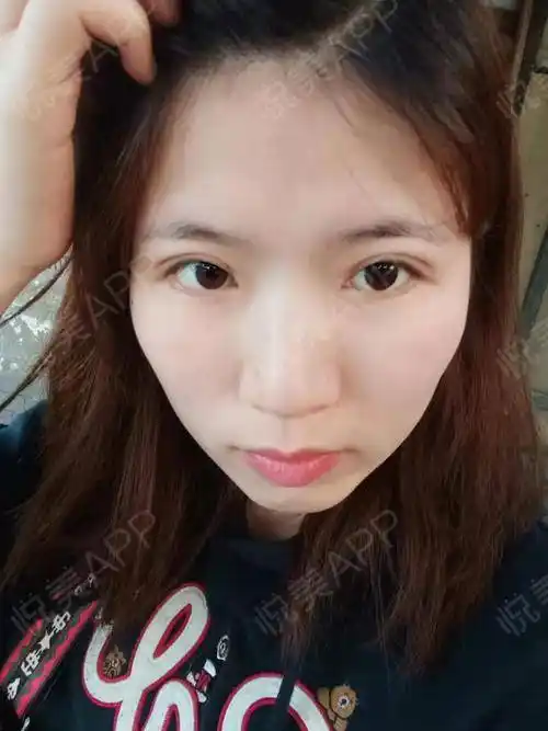 今天是双眼皮术后恢复的第20天,感觉时间过得还算蛮快.