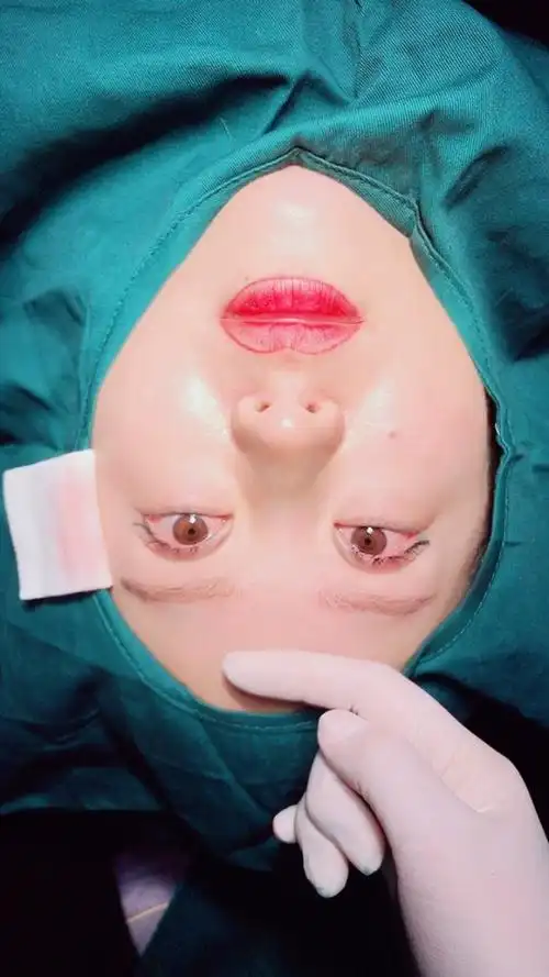 切开双眼皮手术完成 下一项开外眼角77下至