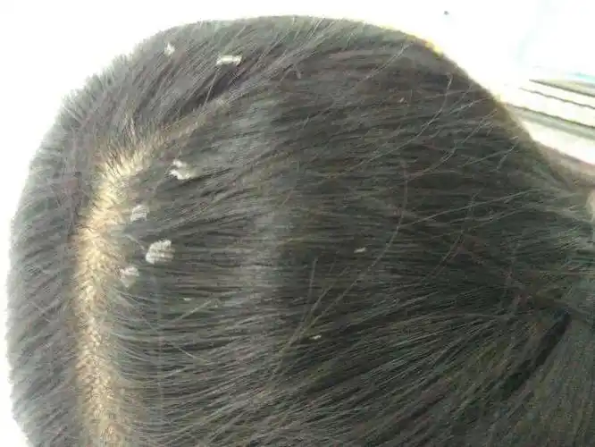 总是头皮发痒,有大块头屑咋办?