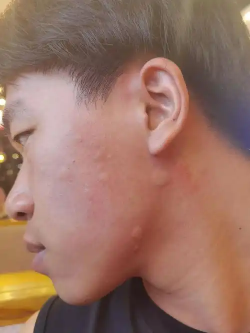 好消息:吃虾了 坏消息:过敏了#吃虾吃虾 #吃货日常 #万万 - 抖音