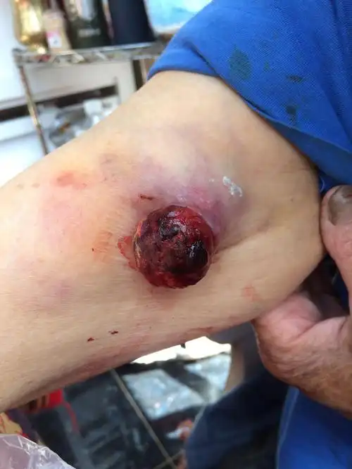 前臂肉瘤中医证治成功案例临床思考