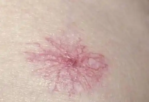 若身体出现这4种"痣"可能是"细胞病变"的信号,早看早受益!