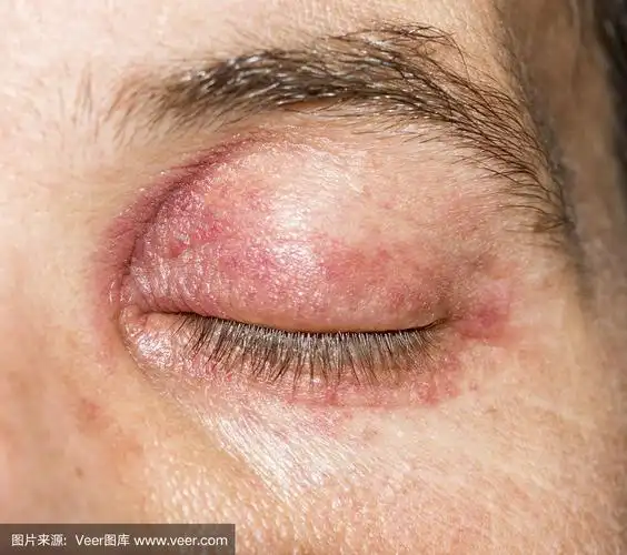 皮肤过敏,眼周发炎,皮疹