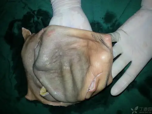 【讨论】头皮撕脱伤再植 [精华] [病例帖]