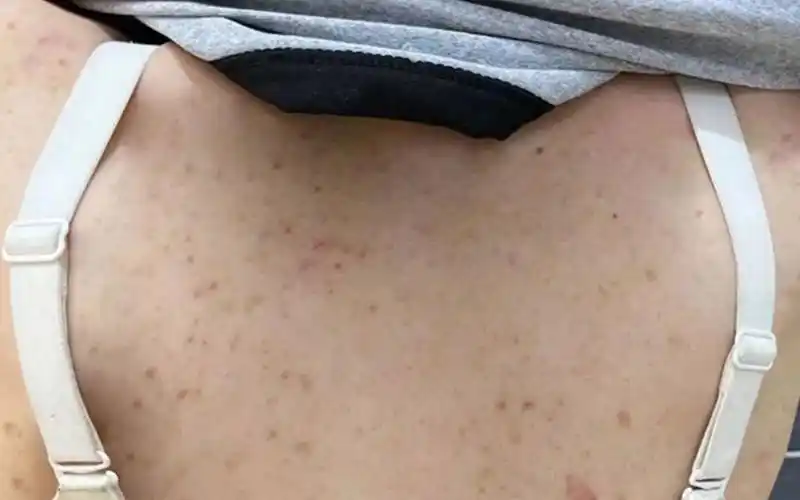 一定是螨虫在搞鬼!改变习惯除螨祛痘很轻松!