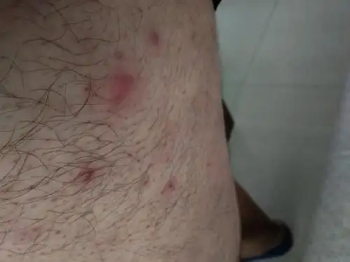 像这种硬块毛囊炎应该涂什么软膏消得快?