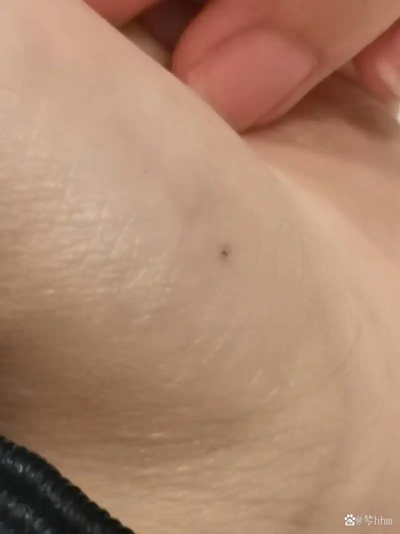 左手长了一颗痣,还是h字母形状 老一辈说左手后天长痣说明有一个特别