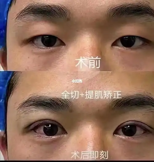 男双眼皮大概前后对比做完手术,大家真的觉得单眼皮更好看吗?