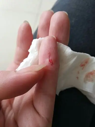 就行了,会不会不够,看网上说要打血清和蛋白的小指头背面也有两个伤口