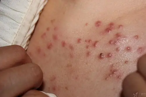 【病例讨论】胸前皮肤长片状红疹