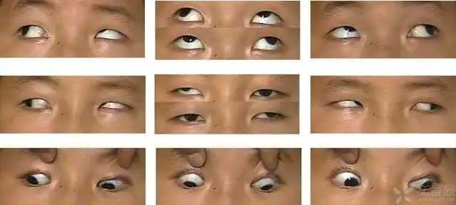 【求助】两例斜视图片,请老师给指导如何诊断.