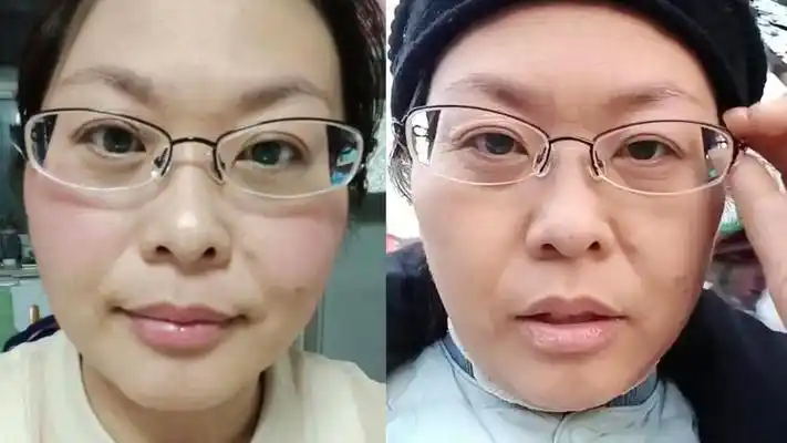 女子20天"断崖式"衰老满脸皱纹,前后素颜照对比扎心:无法逆转