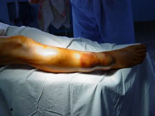 右小腿少见的巨大肿瘤