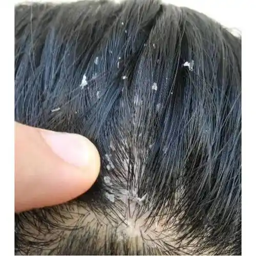 毛囊炎推荐什么洗发水