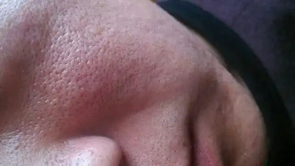 如何改善毛孔粗大