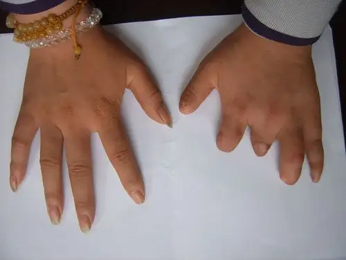 右手食指全断已有十几年现在可以接假肢吗,基本上的活动能完成吗,比如