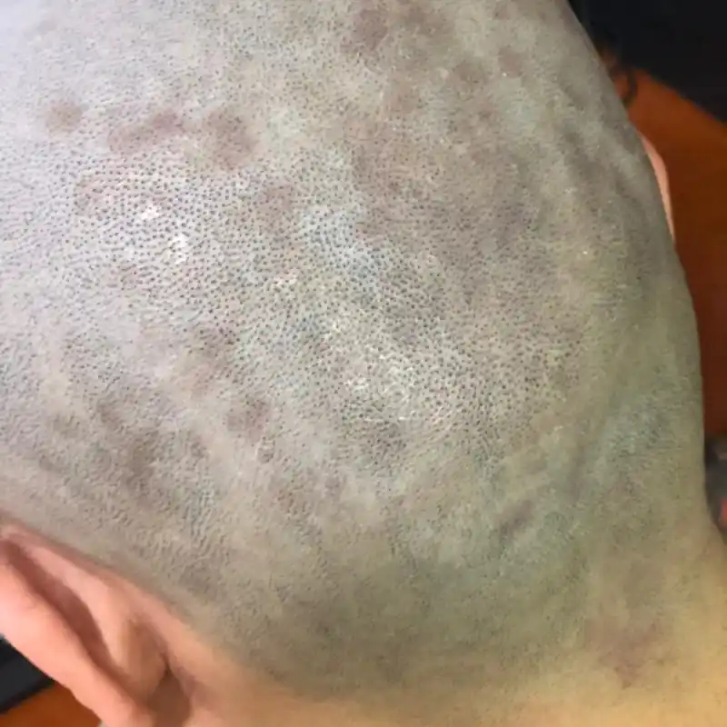 今天给老公剃光头发现他头上好多红点 这个有什么方法可以治么