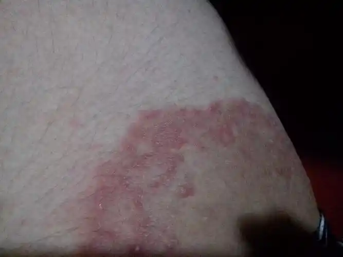 大腿内侧长红色的疹子 该擦什么药