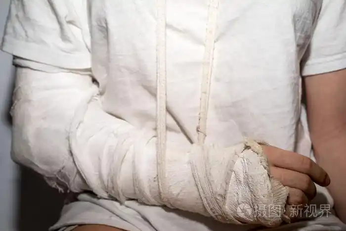 断了的胳膊,脏的白色石膏的女人照片-正版商用图片1l88w4-摄图新视界