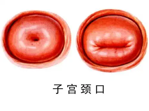 子宫颈口