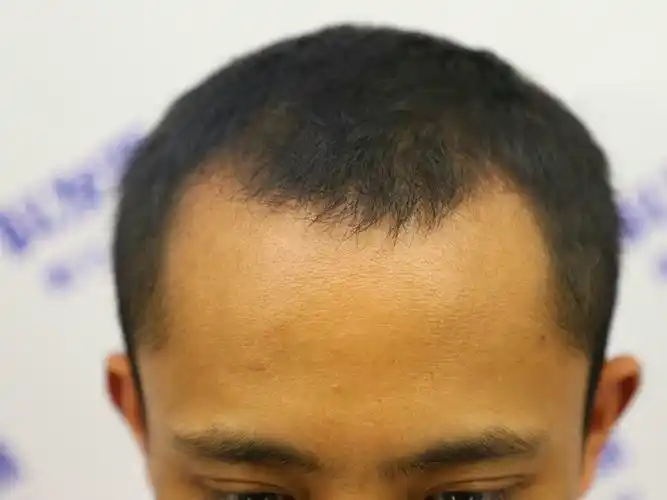 大麦微针植发术后60天:植发两个月了,但是目前头发_圈子-新氧美容整形