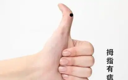 大拇指有痣代表什么1:拇指第一节有痣,性格果断坚决,有意志力,综合