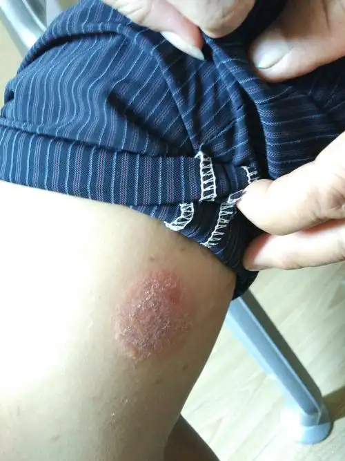 双下肢红斑伴瘙痒半月