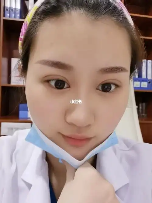 全切双眼皮术后第六天拆线了