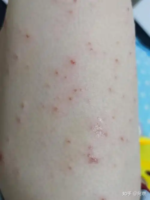 有没有知友帮我看看这是不是丘疹性荨麻疹,之前去医院医生说湿疹但是