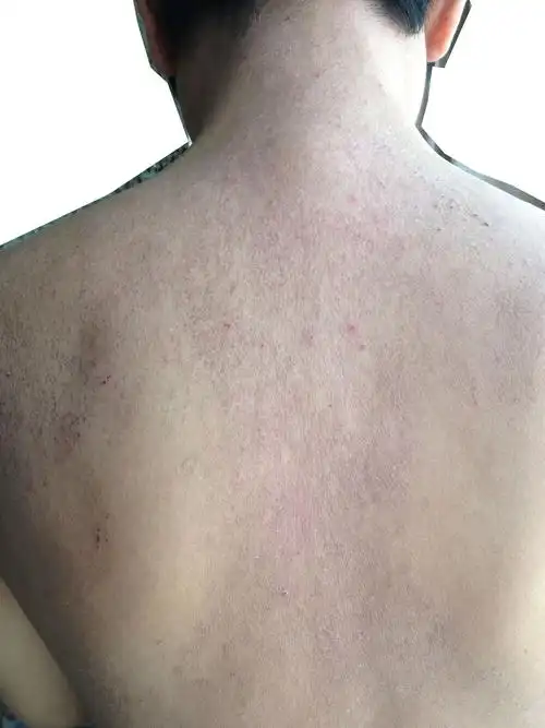 我过敏体质,皮肤经常会这样痒,请问这是湿疹吗,经常累了就会发,很痒