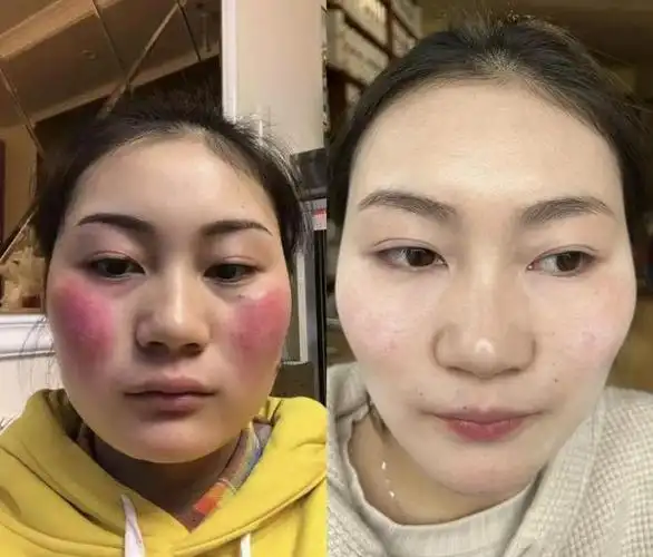 重度高原红红血丝怎么改善过来人紧急支招两步就能搞定