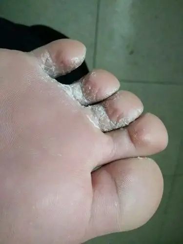 脚怎么会烂成这样子的啊?神马情况导致的呢?