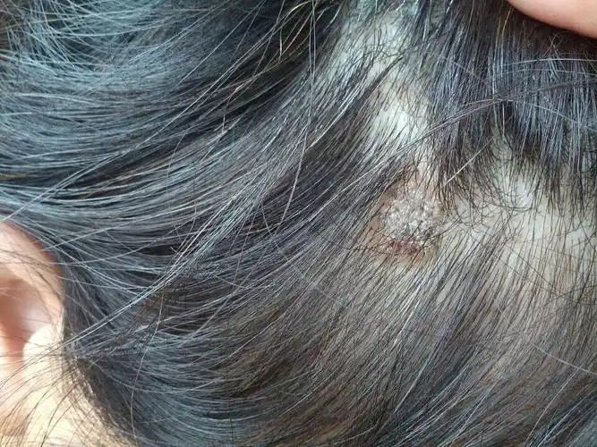 母亲头上一年前头上开始长了一层皮,抓的时候,脱头皮屑样碎屑,开始