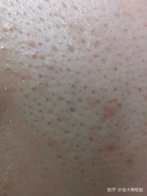 我看到大多数是鼻子上面有黑头,我的是脸颊两边有黑头,怎么去掉?