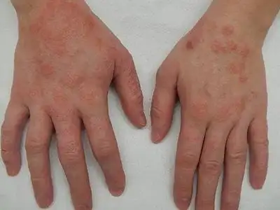 艾滋病感染性皮肤损害的症状和图片 - 有来医生
