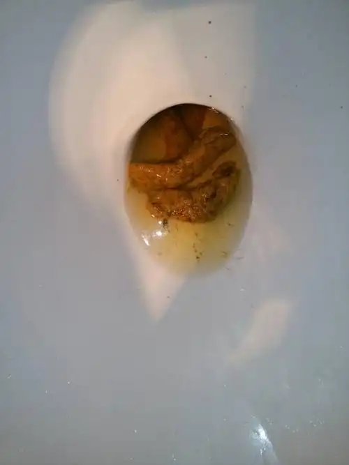 医生帮忙下,我这个大便弯弯的正常吗