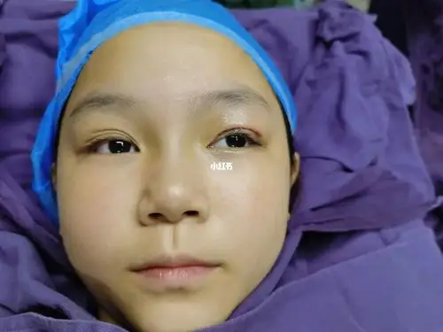 漂亮的小姑娘上睑下垂矫正术后即刻_美妆_医美_整容_美妆_医美整形