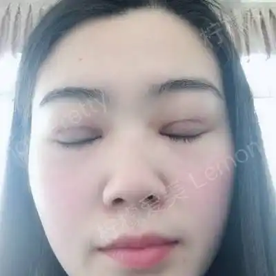 埋线双眼皮〕昨天去医院把线拆了,心里真的超级激动,因为可以看到