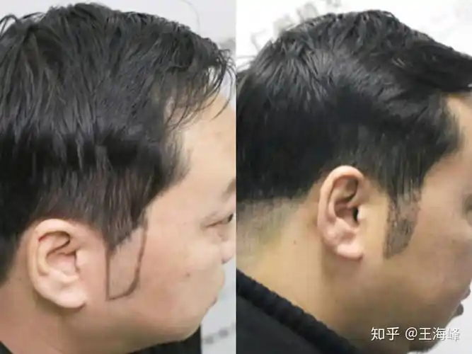 我今年二十岁 鬓角秃得很严重,想去yh植发 但是身边的做其他机构效果