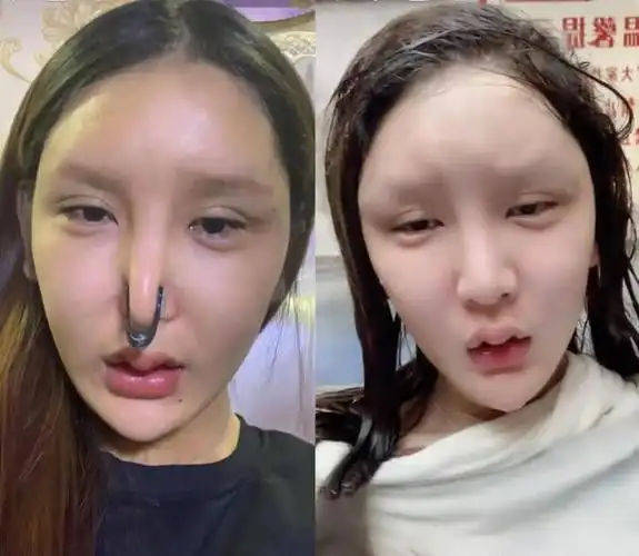 原创网红整容失败,86万打水漂,看见她素颜的样子,才知道医生尽力了
