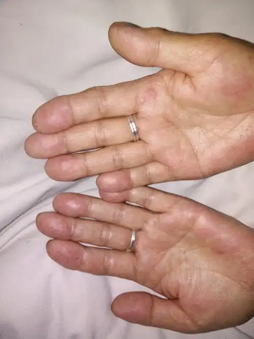 手指头肚发热发麻发胀无疼痛感不发痒