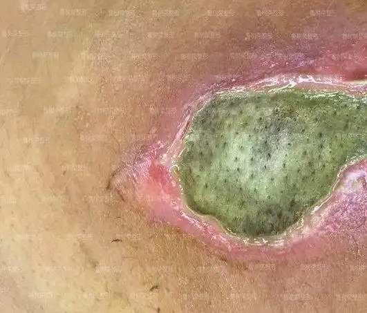 吸脂手术如何避免皮肤坏死