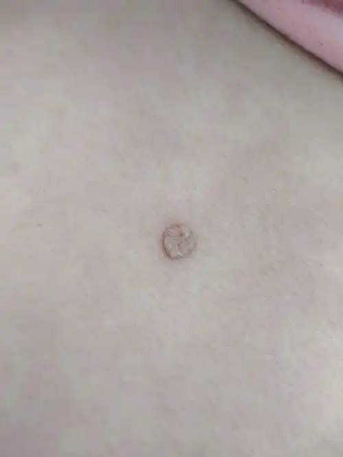 刚开始在意这个小肉球的时候,是因为它很痒,长在后背上我好几年了,也