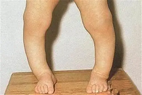 孩子方头颅佝偻病图片