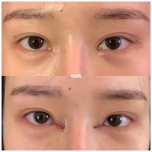 上海蝶羽的包眼角技术真是让我目瞪狗呆!