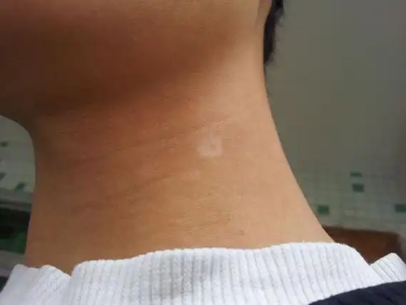 武汉长出白斑是不是白癜风