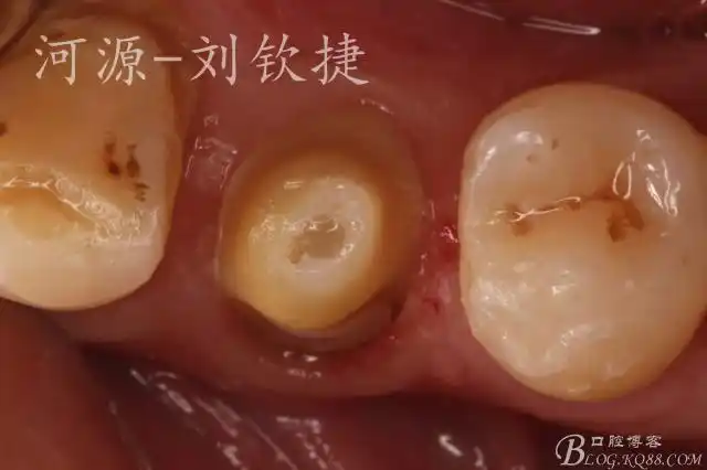 下颌第一前磨牙3根管治疗修复1例