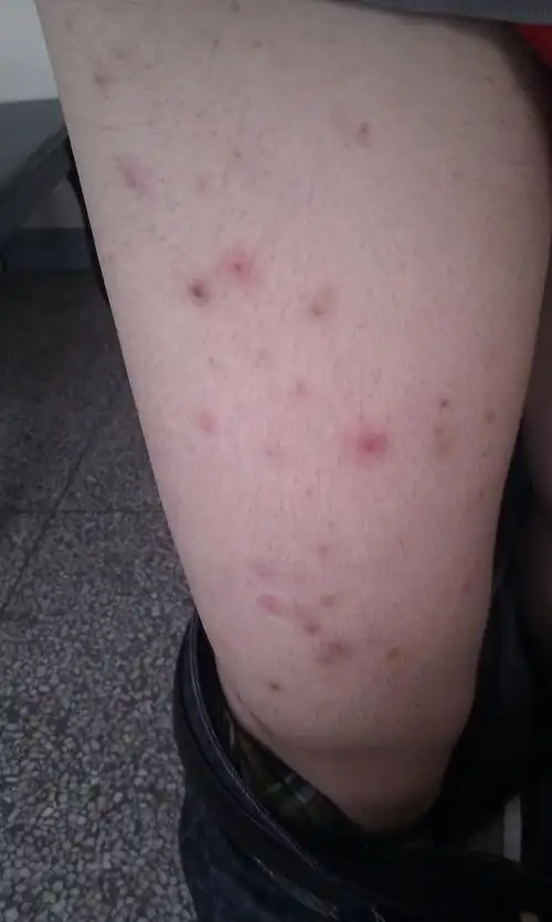 腿上长很多红疙瘩,看起好恶心.