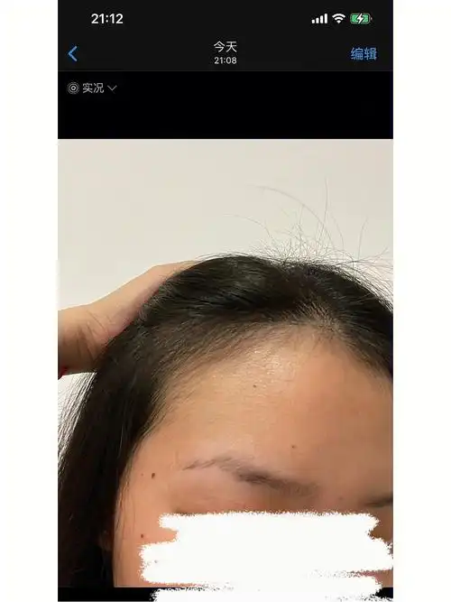 我怀疑九价治好了我的扁平疣