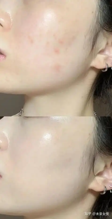 毛孔粗大真的不可逆吗刷酸能收缩毛孔吗